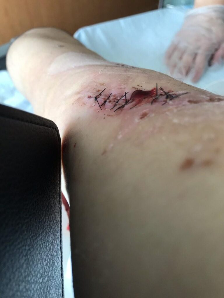 ヒグマから襲われ、現在も後遺症が残っている深い傷（安藤伸一郎氏 提供）